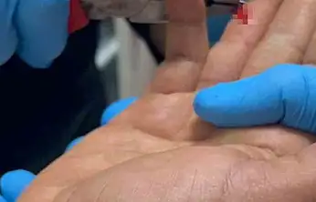 Balık macerası hastanede bitti: Parmağına saplanan olta iğnesini itfaiye çıkarttı