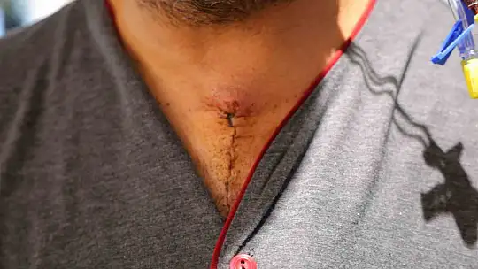 20 dakika beyin dolaşımı durdurulan hasta hayata döndürüldü