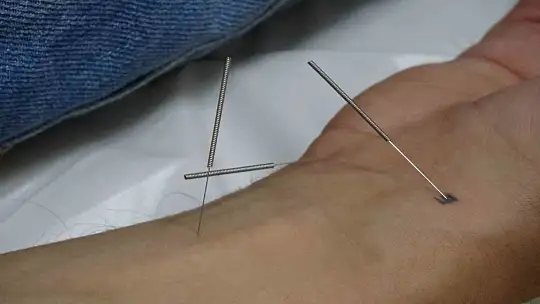 Akupunktur tedavisiyle sağlıklarına kavuştular