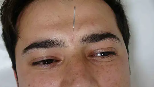 Akupunktur tedavisiyle sağlıklarına kavuştular