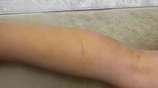 Halfeti'de sahipsiz köpeğin saldırdığı çocuk yaralandı