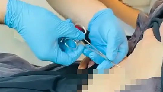 Hastaneye gitti, karnına yapışan kene ile karşılaştı