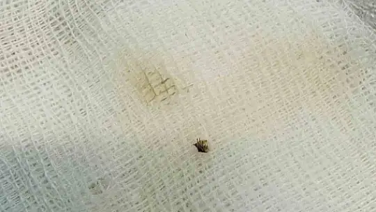 Hastaneye gitti, karnına yapışan kene ile karşılaştı