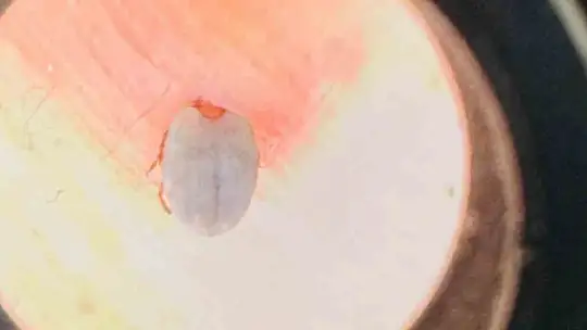 Hastaneye gitti, karnına yapışan kene ile karşılaştı