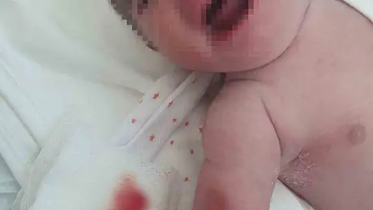 Adıyaman'da kuvöze alınan bebeğin kolu yandı