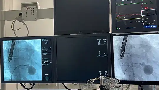Osmaniye'de ilk kez kalp kapağı darlığı ve kalp deliği ameliyatsız yöntemle tedavi edildi