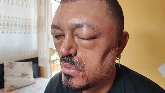 Saçlarını siyahlatmak için aldığı şampuan arı sokmasından beter hale getirdi