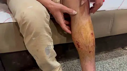 Sahipli köpeğin saldırısına uğrayan adam yaralandı