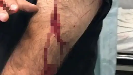 Şanlıurfa'da görev yapan öğretmene sokak ortasında jiletli saldırı