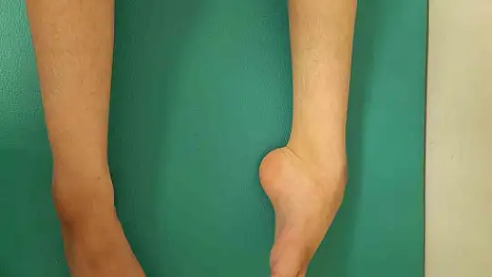 Şanlıurfa'da yatağa bağlı kardeşler tedavi sonrası yürümeye başladı