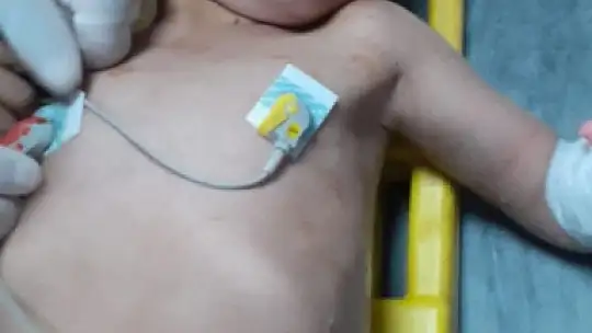 Suriye'de kuyuya düşen çocuk kurtarılarak tedavi için Şanlıurfa'ya getirildi