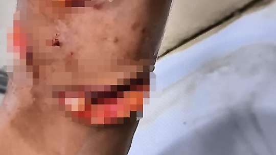 Suruç'ta başıboş köpekler 8 yaşındaki çocuğa saldırdı