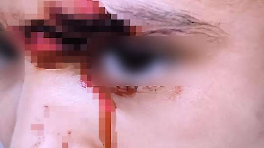 Suruç'ta başıboş köpekler 8 yaşındaki çocuğa saldırdı
