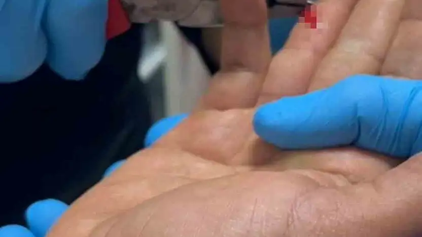 Balık macerası hastanede bitti: Parmağına saplanan olta iğnesini itfaiye çıkarttı